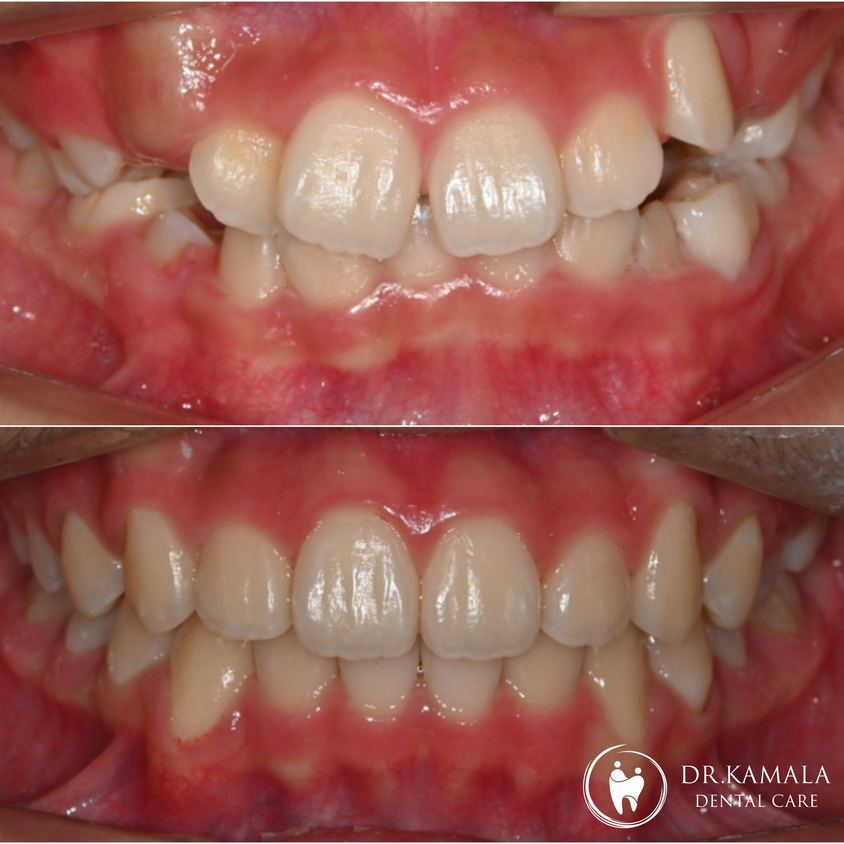 KAMALA DENTAL- Before & After 01.jpg