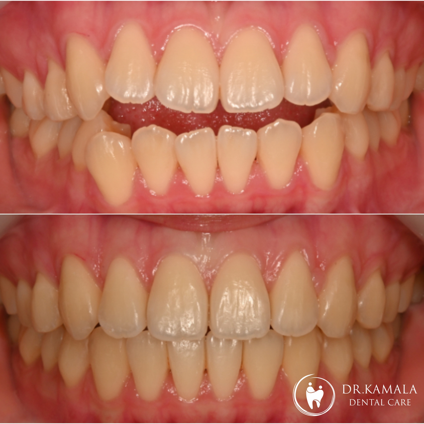 KAMALA DENTAL- Before & After 02.jpg