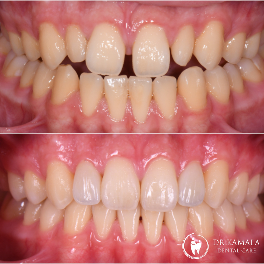 KAMALA DENTAL- Before & After 03.jpg