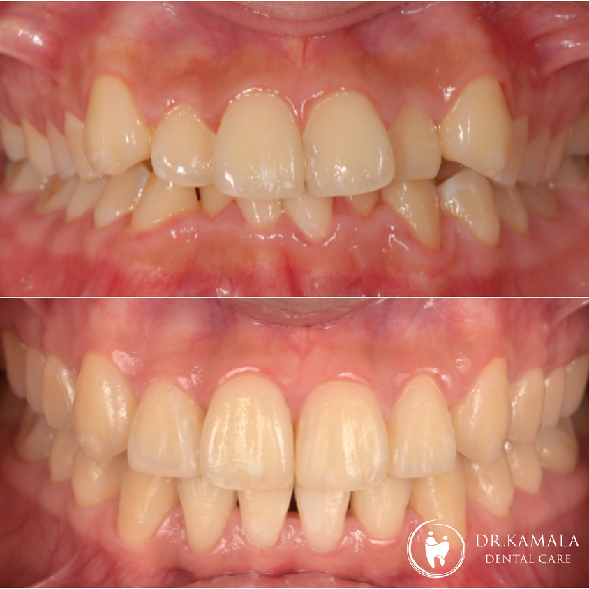 KAMALA DENTAL- Before & After 04.jpg