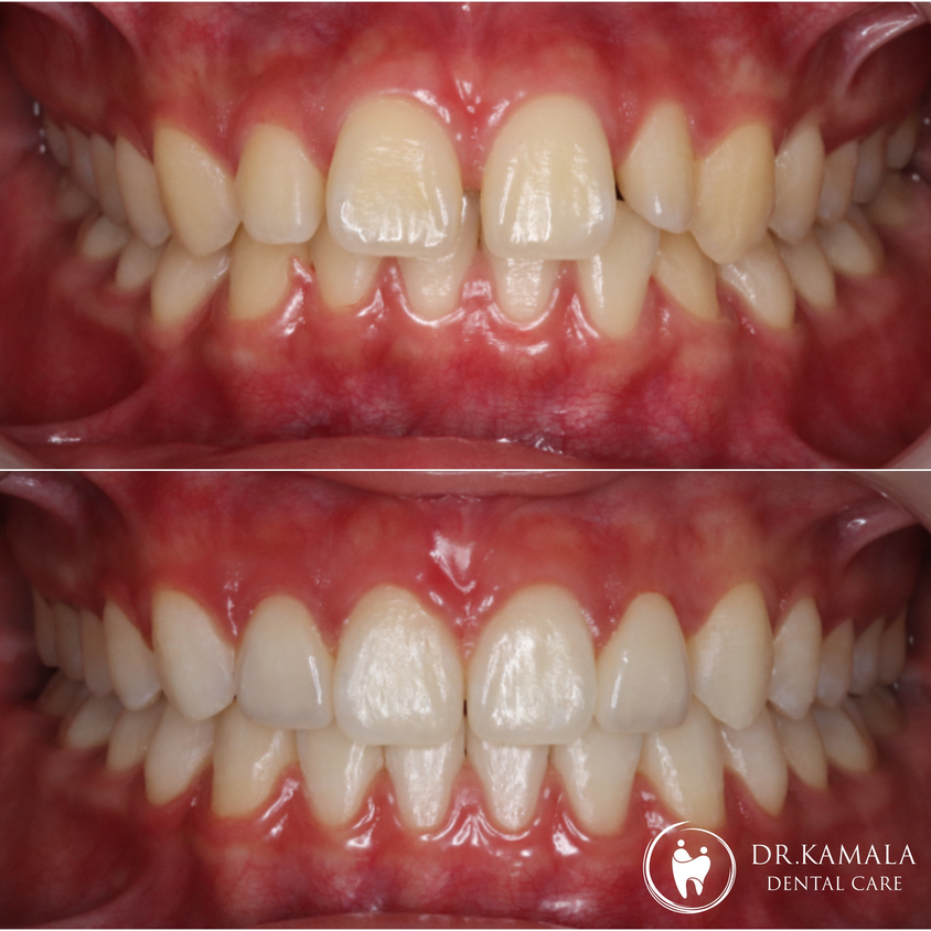 KAMALA DENTAL- Before & After 05.jpg